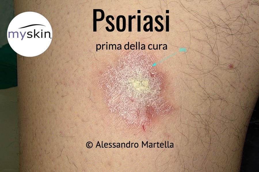 Psoriasi immagine di macchia rossa e crostosa