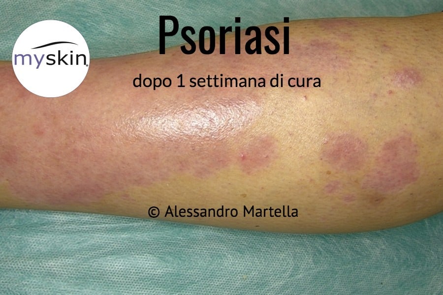 Macchia rossa di Psoriasi in trattamento