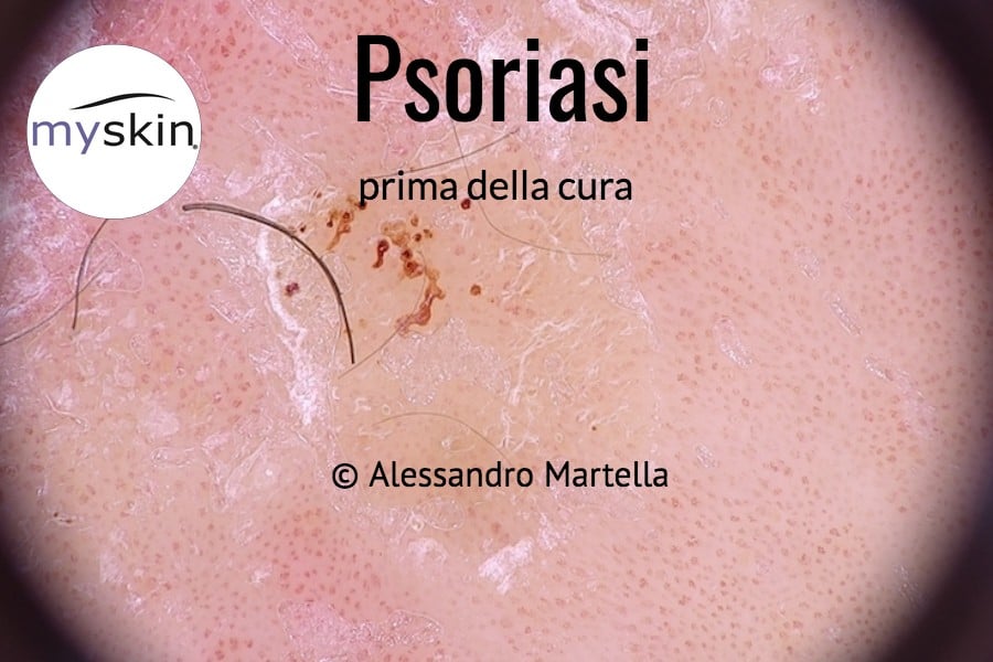 Psoriasi osservata in dermoscopia