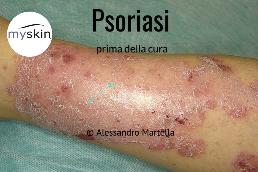 Macchia rossa e squamosa di Psoriasi