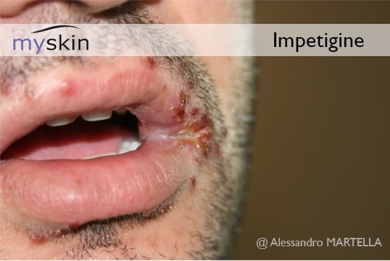 Impetigine alle labbra in uomo adulto