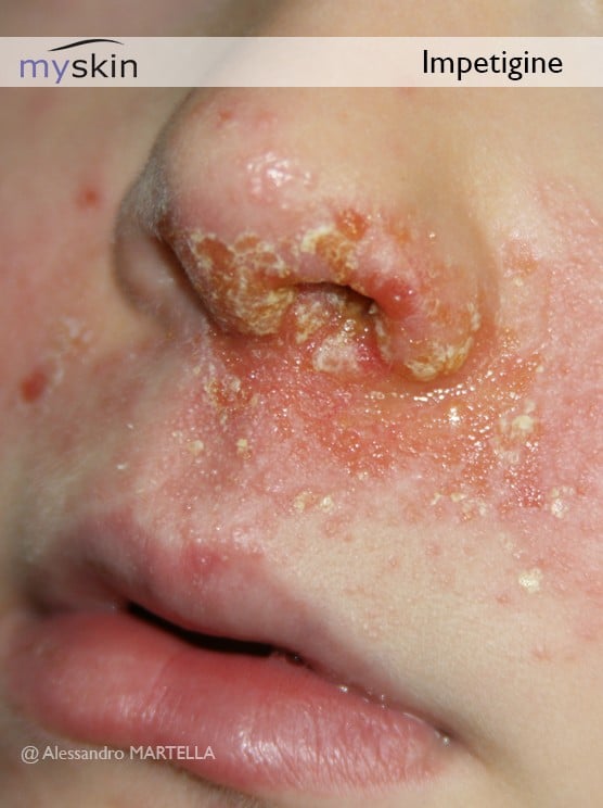 Immagini di Impetigine sul volto