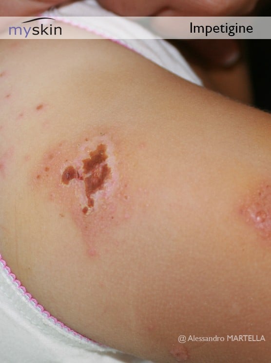 Impetigine: una delle più diffuse e contagiose infezioni superficiali della pelle