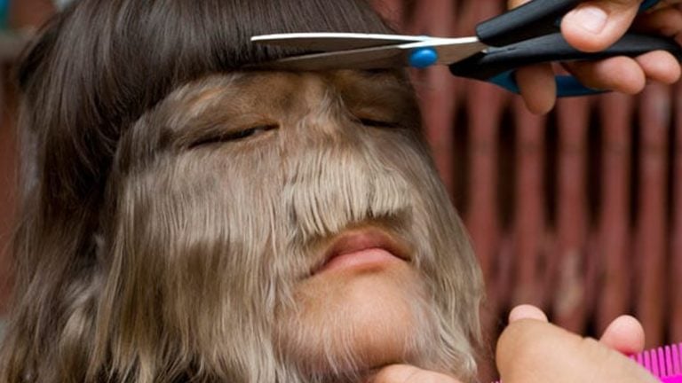 Ipertricosi : cause, sintomi e tipi