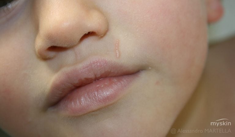 Molluschi contagiosi