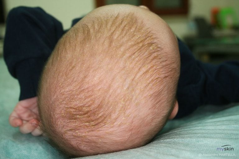 Crosta lattea del neonato : sintomi e trattamento
