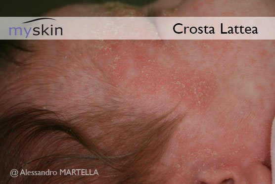 Crosta lattea del neonato : sintomi e trattamento - Myskin - Dermatologi  Online