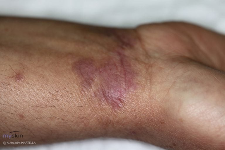 Lichen planus: sintomi e trattamento