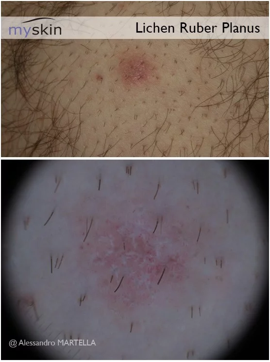 Il dermatologo può analizzare mediante dermoscopia l'eruzione cutanea per definirne meglio la natura.