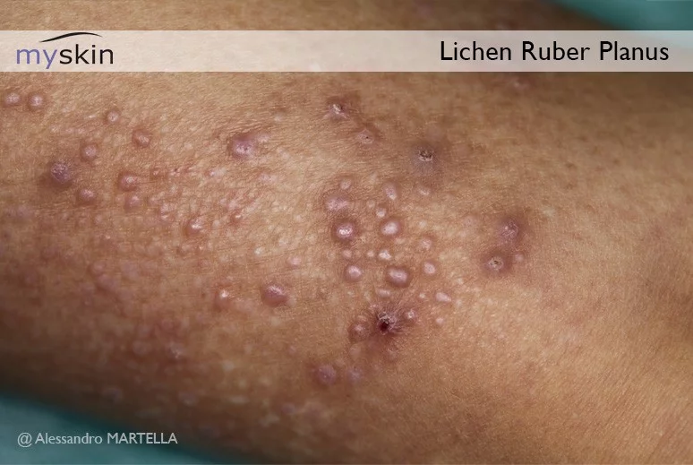 Il lichen planus si sviluppa quando il sistema immunitario attacca la pelle creando delle eruzioni cutanee.