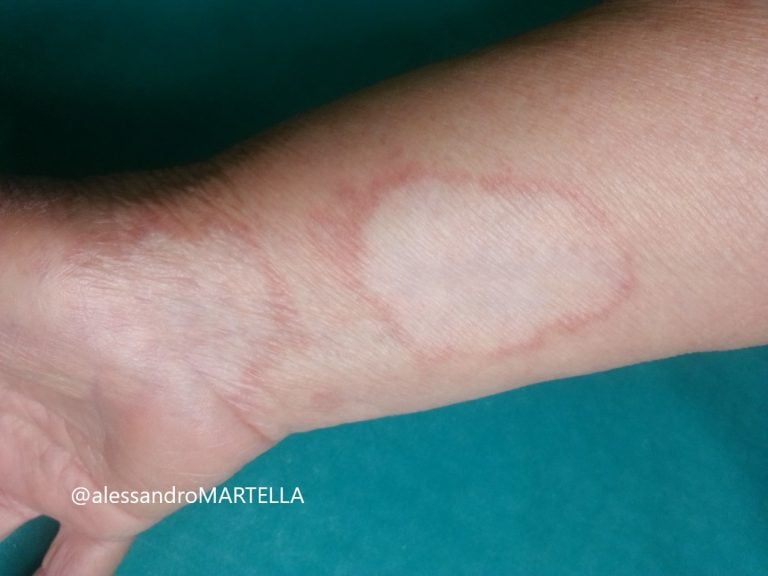 Morfea : cause, sintomi e trattamento