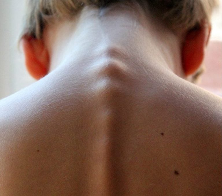 Impatto prognostico della regressione nei pazienti con Melanoma primario > 1mm di spessore