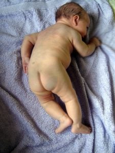 La macchia mongolica in neonato