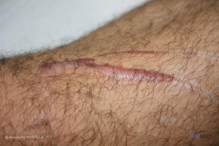 Le cicatrici ipertrofiche: cause e trattamento