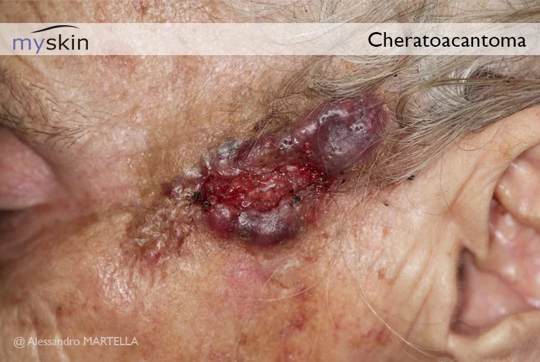 Immagine: Cheratoacantoma Immagine: Cheratoacantoma