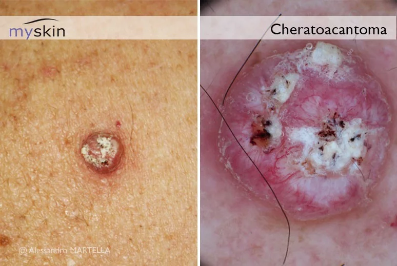 Immagine: Cheroacantoma (visione dermatoscopica) Immagine: Cheroacantoma (visione dermatoscopica)