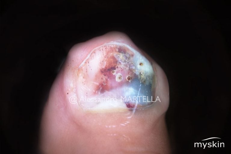 Ematoma subungueale o unghia nera: sintomi e trattamento