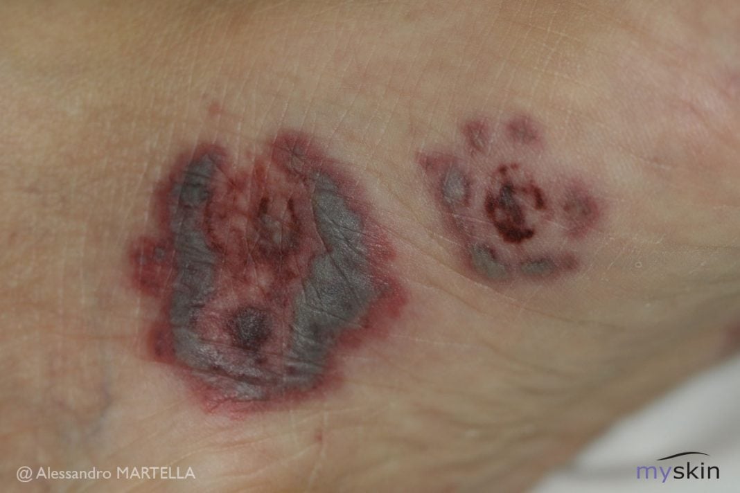 Eritema multiforme come riconoscerlo e curarlo Myskin Dermatologi