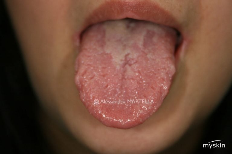 Lingua tagliata o scrotale: cause e rimedi