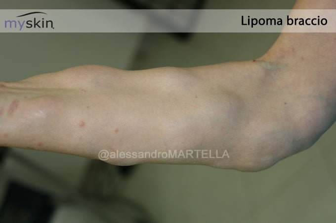 Lipoma-braccio