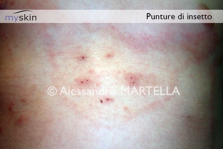 Puntura di insetto cosa fare Myskin Dermatologi Online