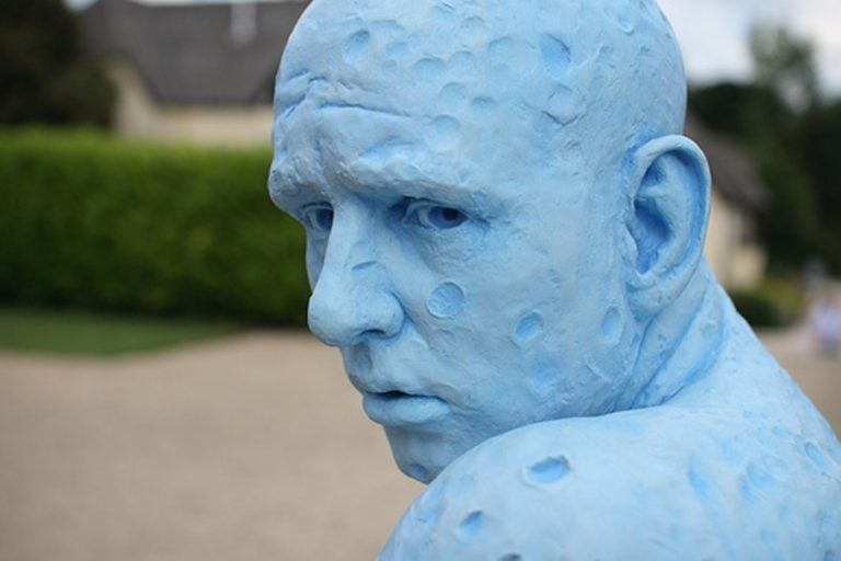 Argiria: quando la pelle diventa blu