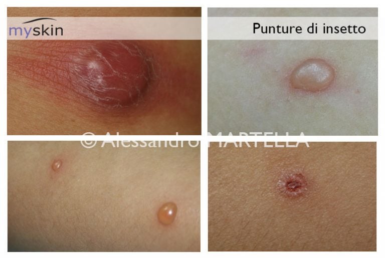Puntura di insetto cosa fare Myskin Dermatologi Online