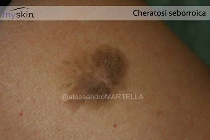 cheratosi seborroica cuoio capelluto terapia