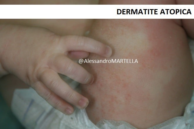 dermatite-atopica-neonato