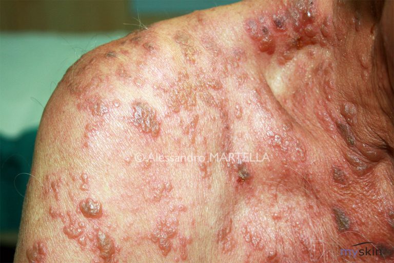 10 rimedi fai da te per l’herpes zoster