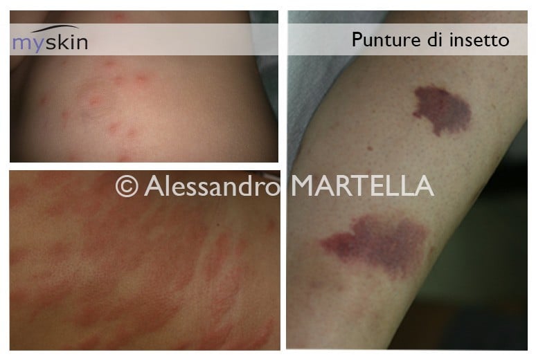 Puntura di insetto cosa fare Myskin Dermatologi Online