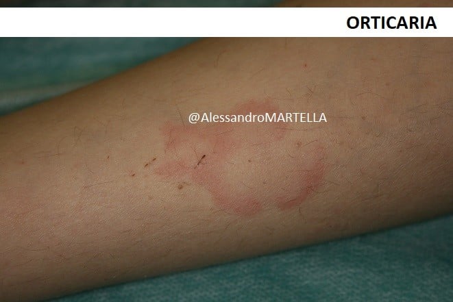 orticaria