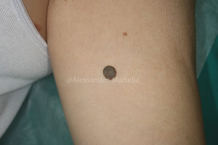 Verruca seborroica: cosa fare