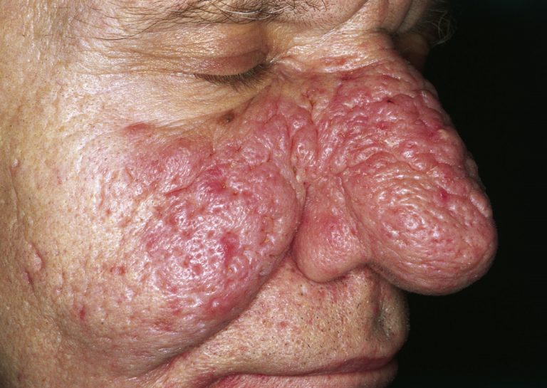 Rinofima: sintomi e trattamento