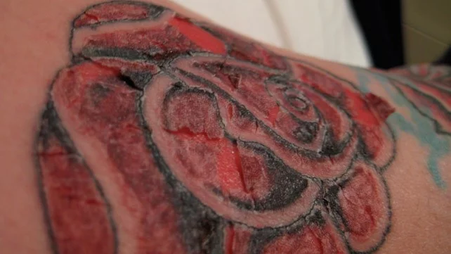 tatuaggio-infetto