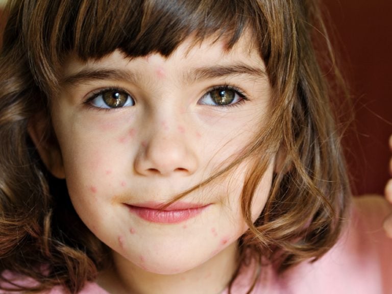 Varicella vs Morbillo: come riconoscerle e come curarle