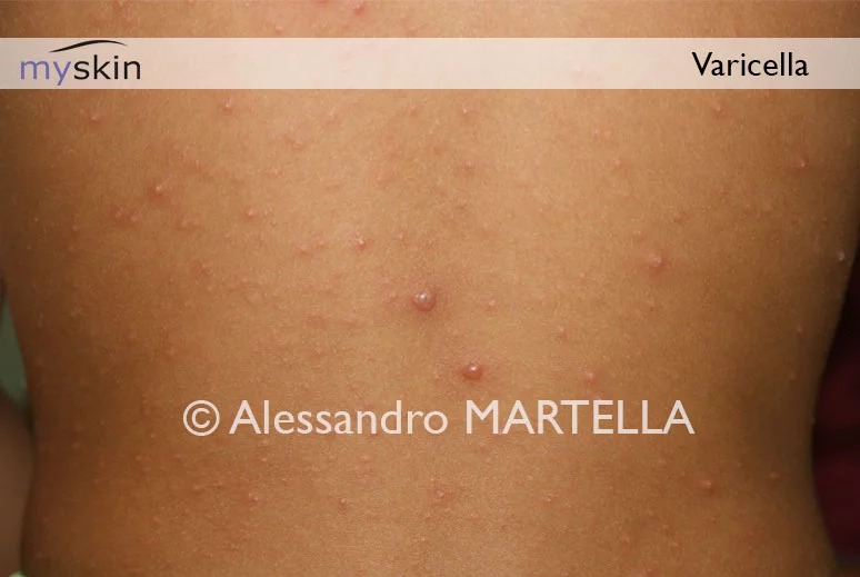 Eruzione cutanea tipica della varicella