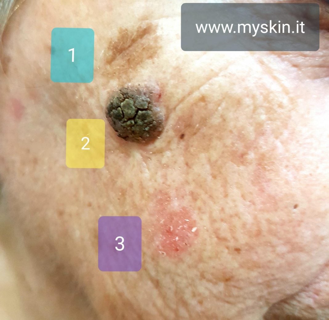 Tumori della pelle come riconoscerli Myskin Dermatologi Online