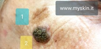 Tumori della pelle: come riconoscerli Tumori della pelle - Myskin
