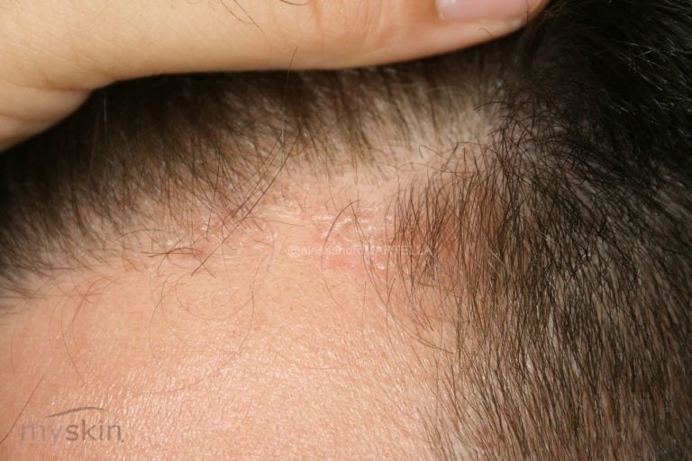 Come distinguere la Psoriasi e la Dermatite Seborroica alla testa?
