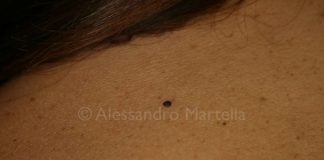 Foto di Nevo Displastico ©Myskin