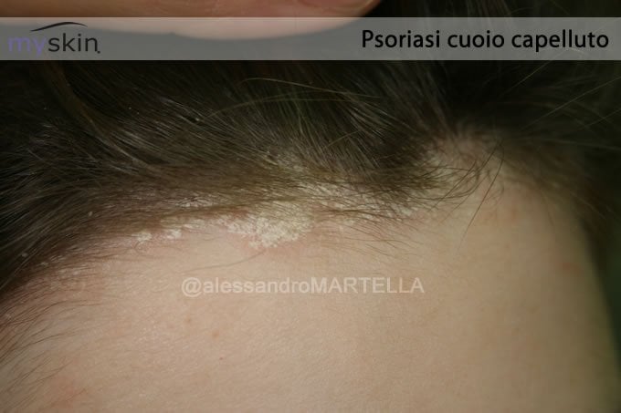 psoriasi-cuoio-capelluto