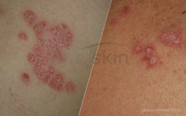 Psoriasi e Lupus: quali sono le differenze?