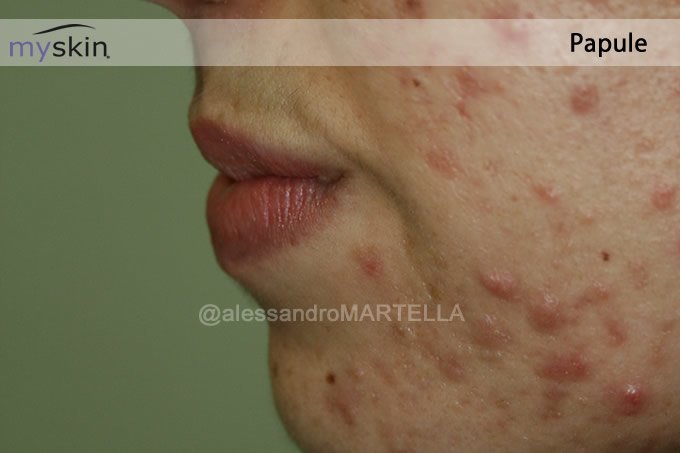 acne-papule