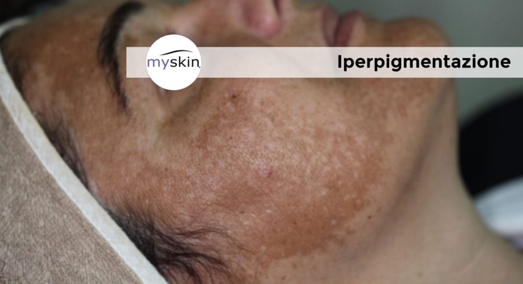 Iperpigmentazione Macchie Scure Sulla Pelle Quali Sono I Rimedi 