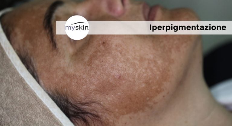Iperpigmentazione: macchie scure sulla pelle quali sono i rimedi?