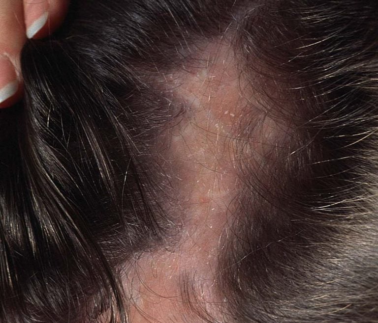 Alopecie cicatriziali acquisite primitive