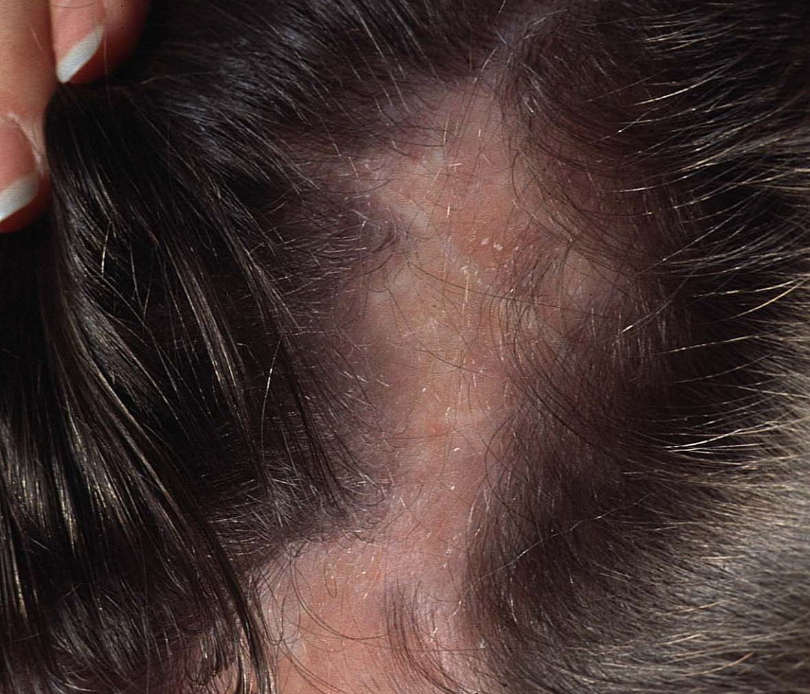 Alopecie Cicatriziali Acquisite Primitive Myskin Dermatologi Online