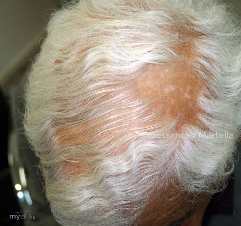 Alopecia fibrosante: cosa è, come e perché si manifesta