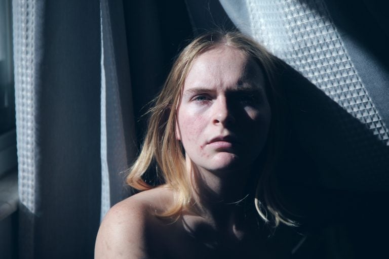 Cicatrici da Acne? Combattile con il Needling